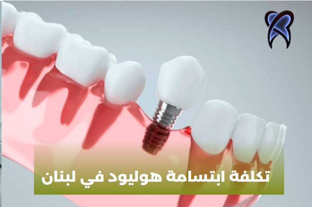 تكلفة ابتسامة هوليود في لبنان