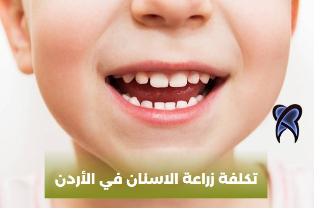 تكلفة زراعة الاسنان في الأردن
