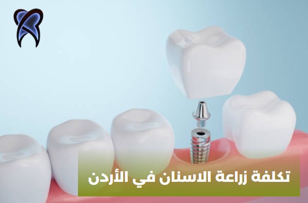 تكلفة زراعة الاسنان في الأردن