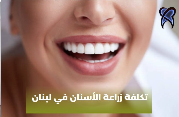 تكلفة زراعة الاسنان في تركيا