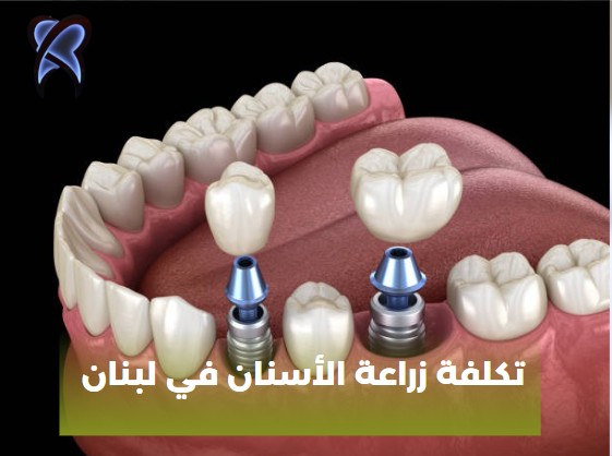 تكلفة زراعة الاسنان في تركيا