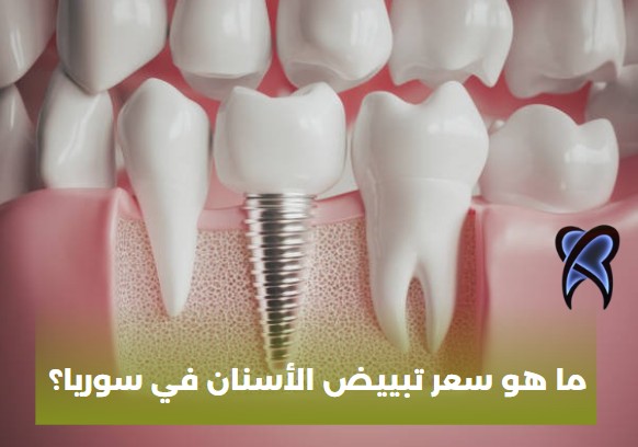 ما هو سعر تبييض الأسنان في سوريا؟