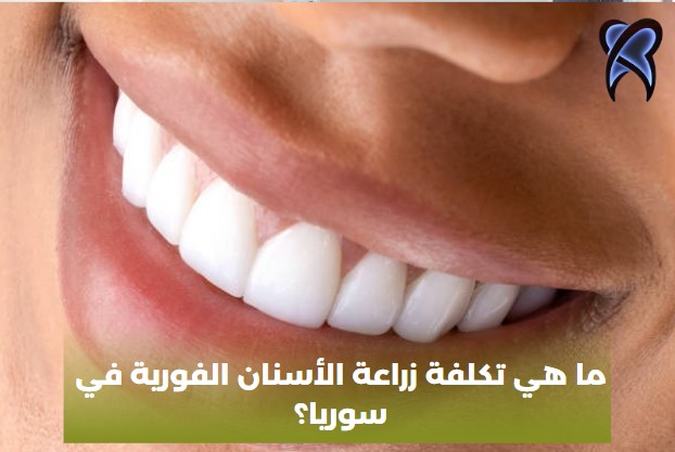 كيف تتم زراعة الأسنان الفورية؟