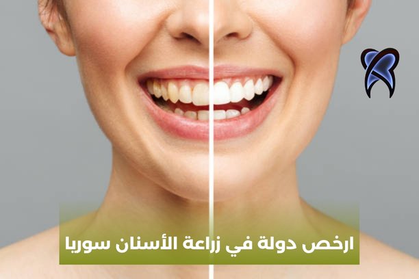 أرخص دولة في زراعة الأسنان سوريا أرخص دولة في زراعة الأسنان سوريا