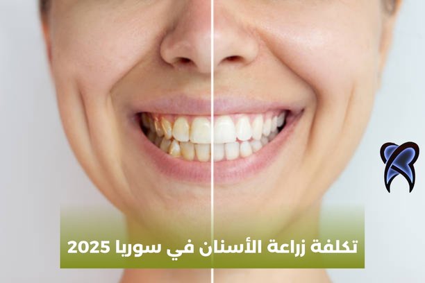 كم تكلفة زراعة الأسنان في سوريا 2025 كم تكلفة زراعة الأسنان في سوريا 2025
