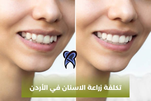 تكلفة زراعة الاسنان في الأردن