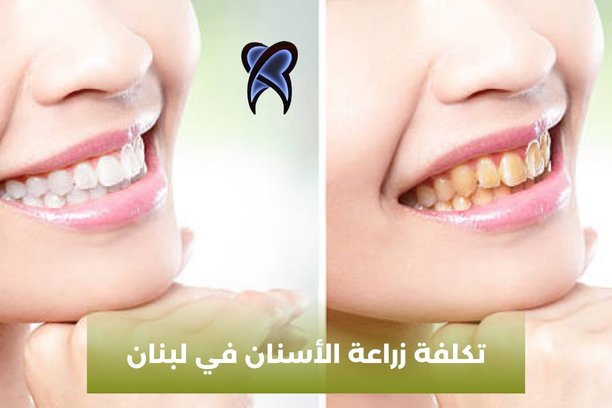 تكلفة زراعة الأسنان في لبنان