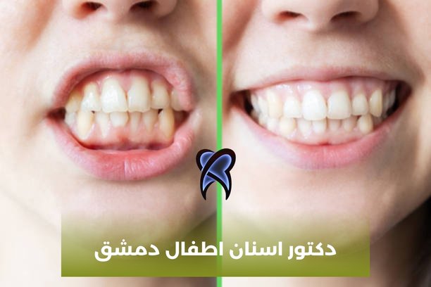 دكتور أسنان اختصاص لبية دمشق