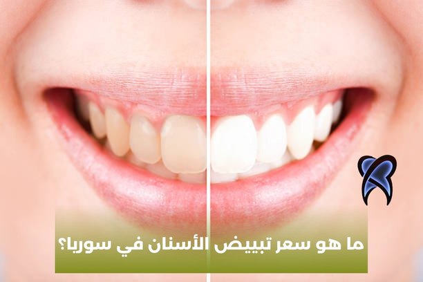 ما هو سعر تبييض الأسنان في سوريا؟