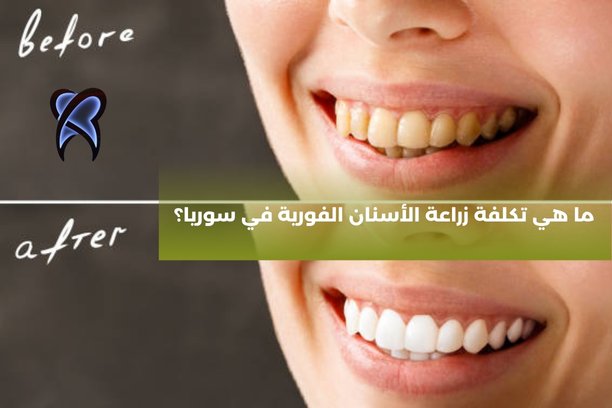 ما هي تكلفة تركيب السن الواحد في سوريا؟