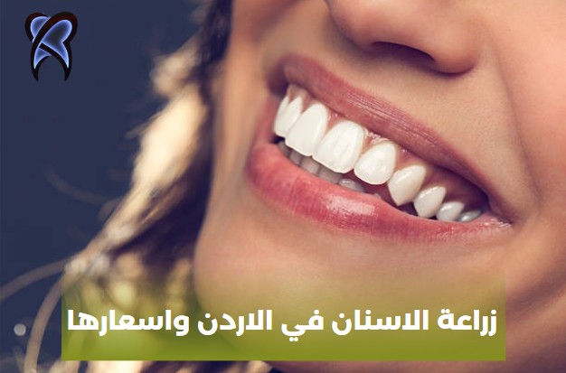 زراعة الاسنان في الاردن واسعارها