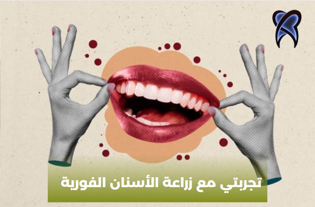 زراعة الاسنان فورية