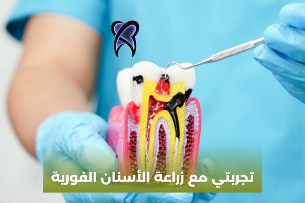تجربتي مع زراعة الأسنان الفورية تجربتي مع زراعة الأسنان الفورية
