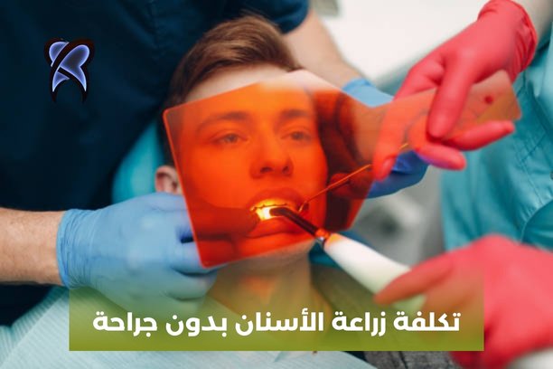 زراعة الأسنان بدون براغي