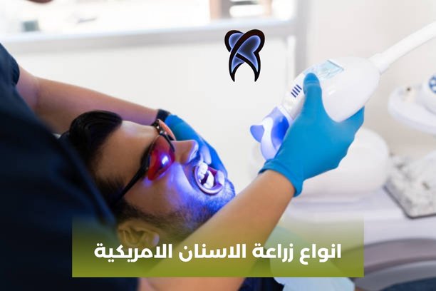 أنواع زراعة الأسنان الأمريكية