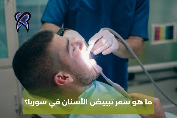 كم تكلفة الفينير في سوريا؟