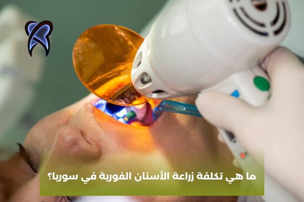 ما هي تكلفة زراعة الأسنان الفورية في سوريا؟
