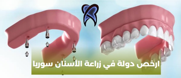 ارخص دولة في زراعة الأسنان سوريا