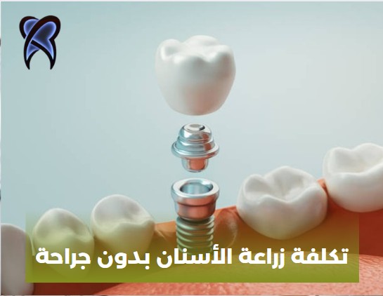 تكلفة زراعة الأسنان بدون جراحة