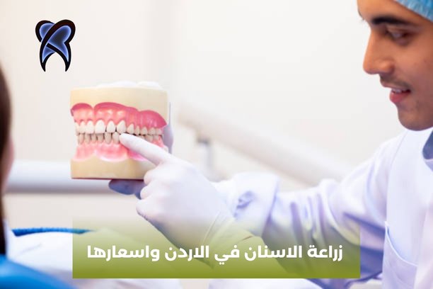 تكلفة زراعة الاسنان في الاردن