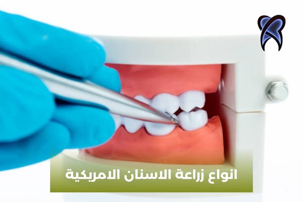 أنواع زراعة الأسنان الألمانية