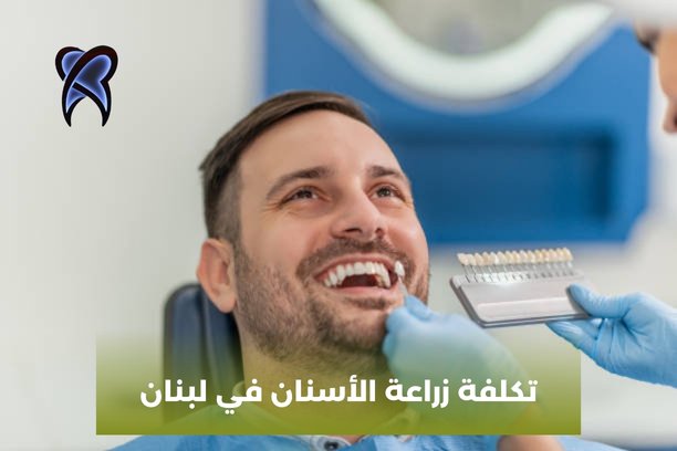 ما هي تكلفة زراعة الاسنان في لبنان