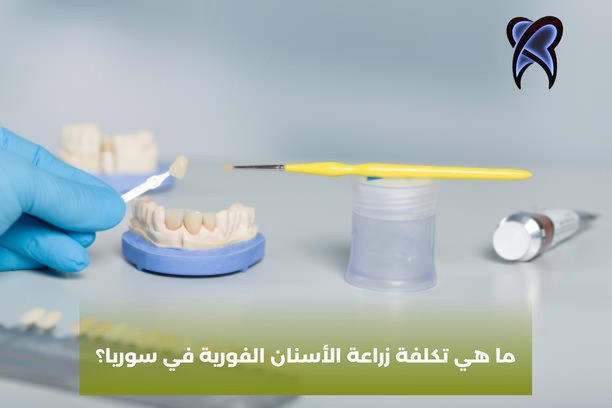 كم تكلف زراعة الأسنان في ألمانيا؟