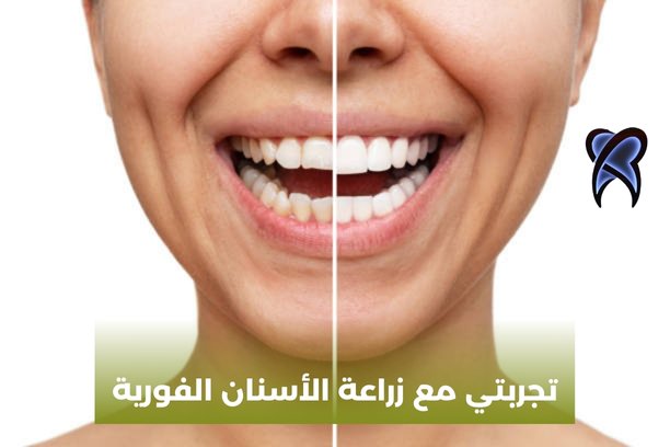 زراعة وتجميل الاسنان زراعة وتجميل الاسنان