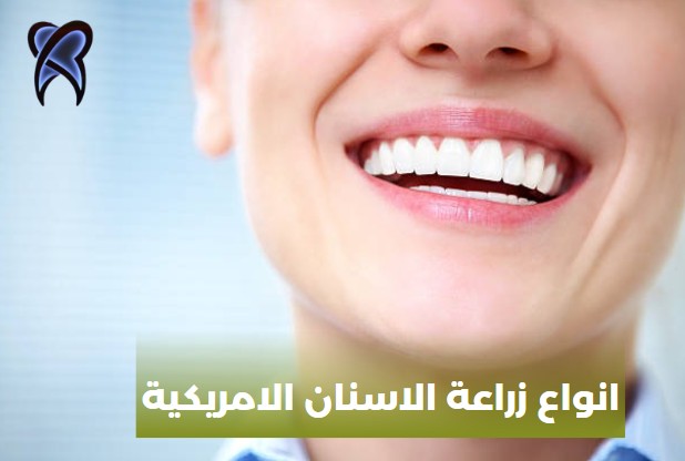 أنواع زرعات الأسنان الألمانية