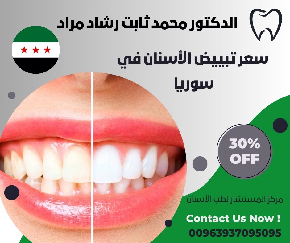 سعر تبييض الأسنان في سوريا
