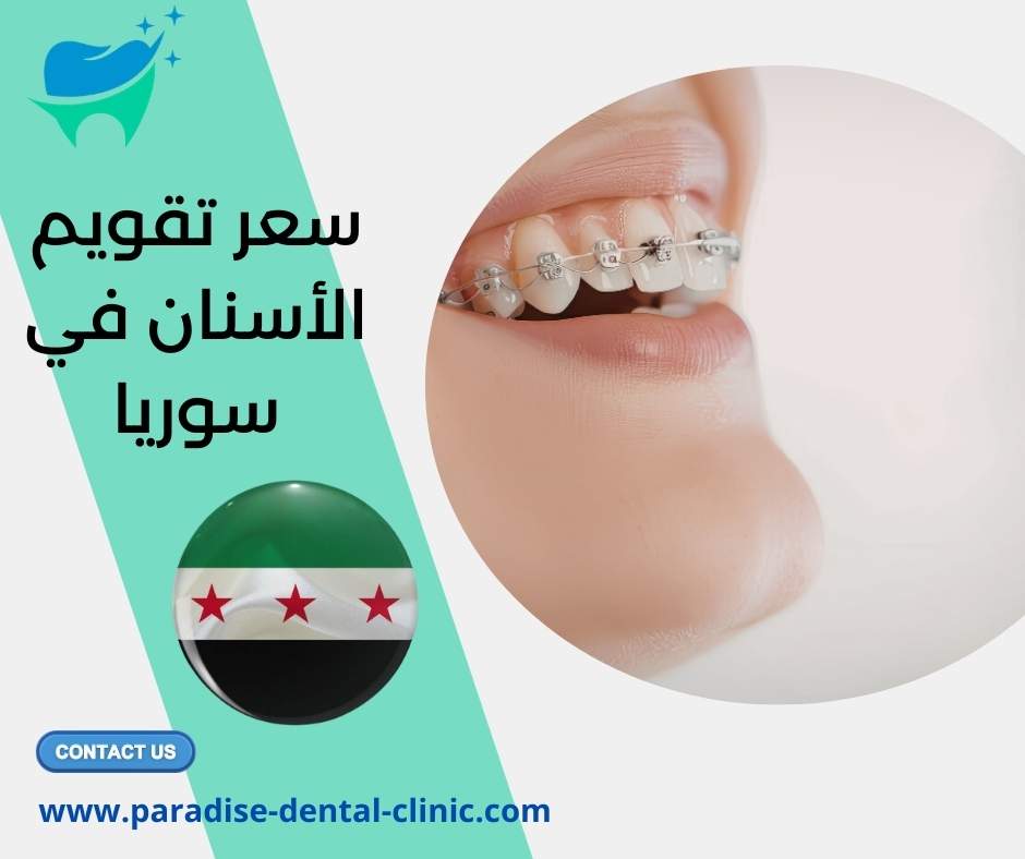سعر تقويم الأسنان في سوريا