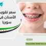 سعر تقويم الأسنان في سوريا