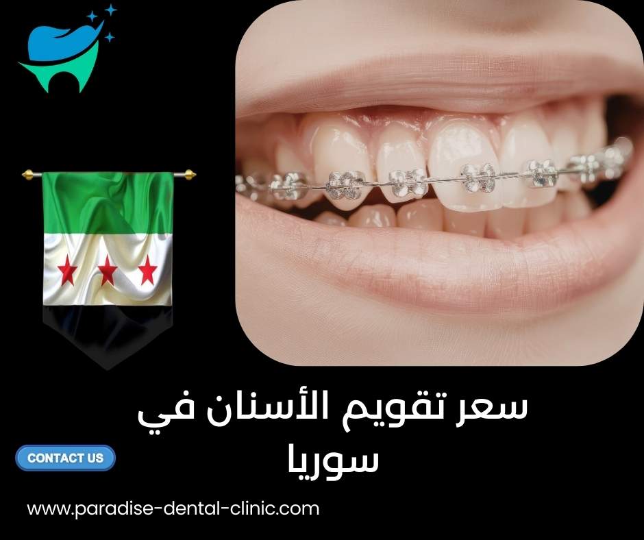 سعر تقويم الأسنان في سوريا