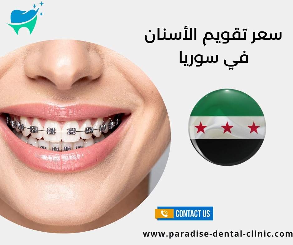 سعر تقويم الأسنان في سوريا