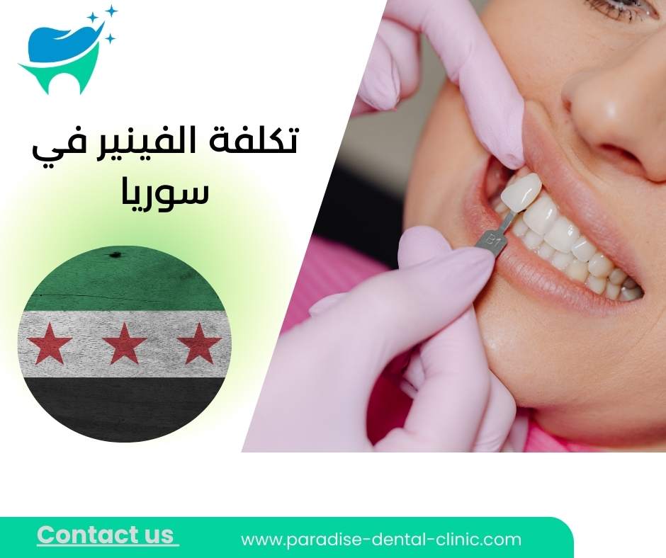 تكلفة الفينير في سوريا
