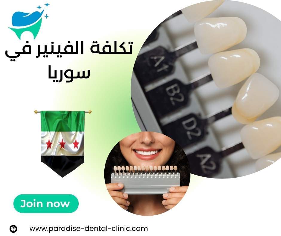 تكلفة الفينير في سوريا